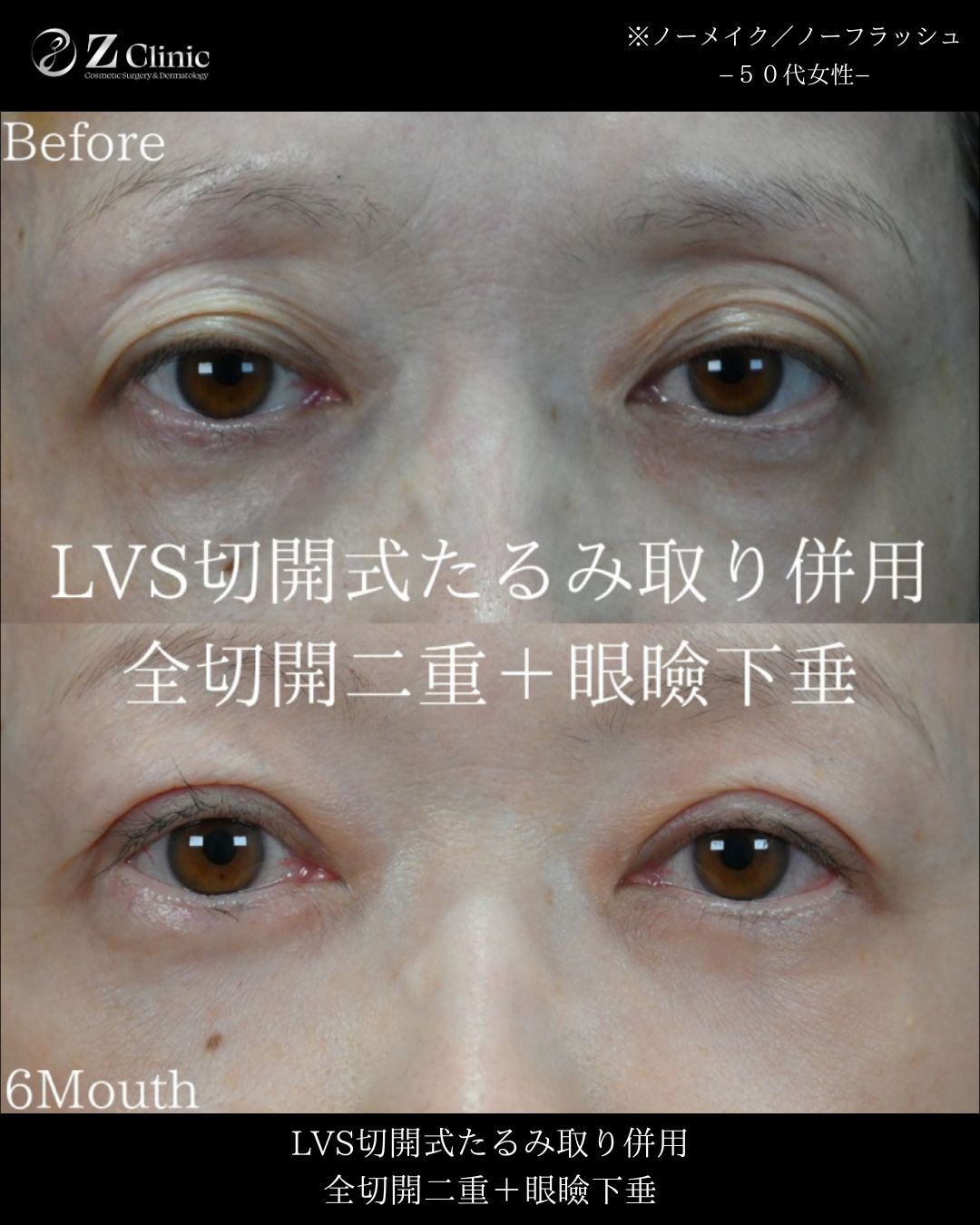 東京・銀座で眉下切開・眉下リフトの美容クリニックzclinicの情報